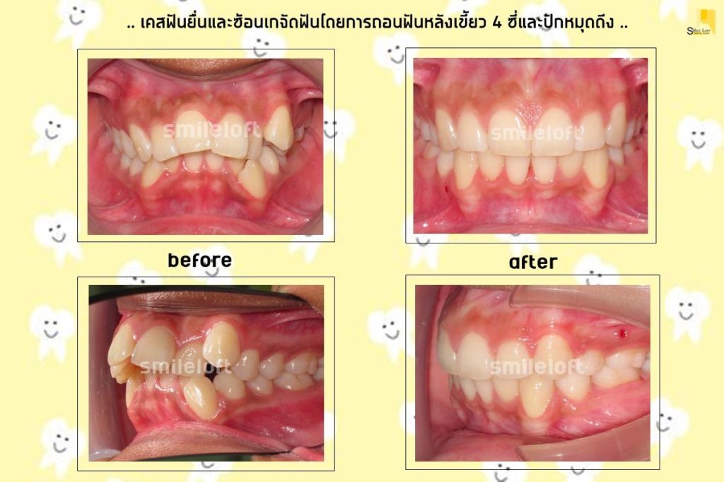 รีวิวจัดฟัน