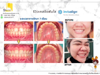 Review case Invisalign