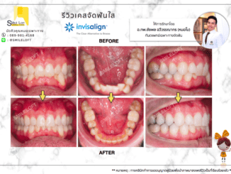 Review case Invisalign 2